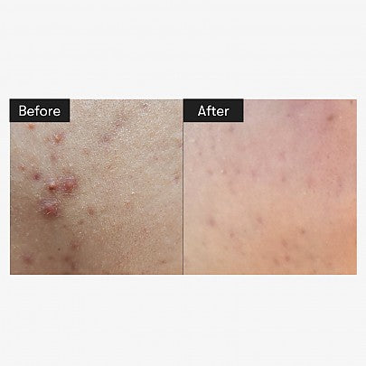 REEDLE SHOT 100 +REEDLE SHOT 300 (1ML*3EA) set